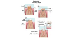 root canal thakurgaon